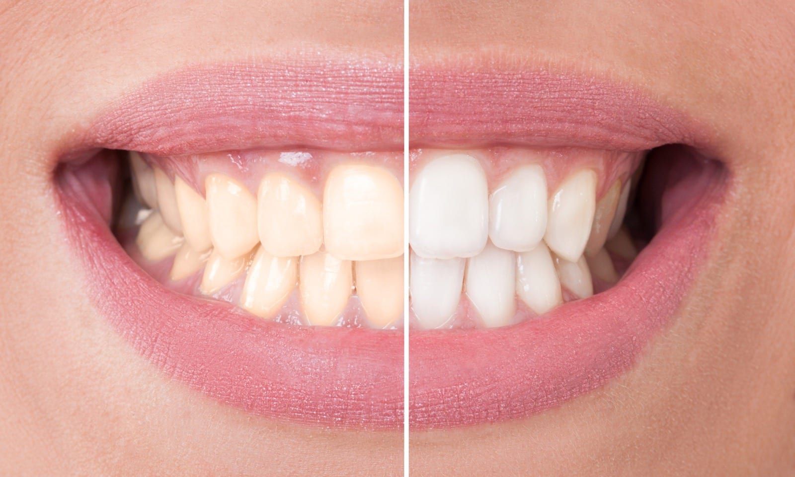 Savannah Teeth Whitening - KöR Whitening Deep Bleaching
